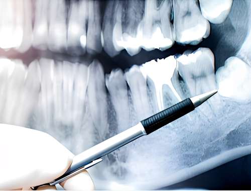 Wisdom_Teeth