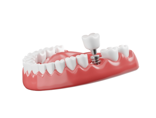 Dental_Implants