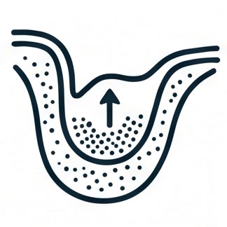Sinus Lift